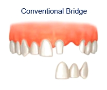 dental bridgework sheffield, dental care Sheffield, lost tooth, smile makeover, improve smile, missing teeth